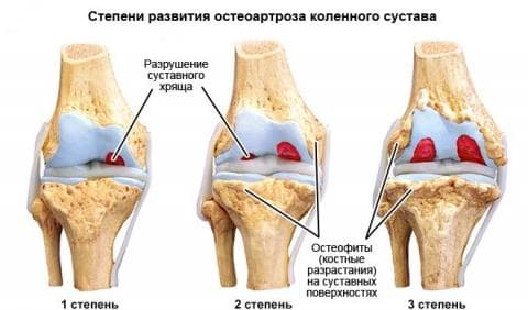 Остеоартроз (артроз, гонартроз) коленного сустава