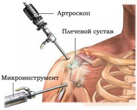 Артроскопия плечевого сустава в Красноярске