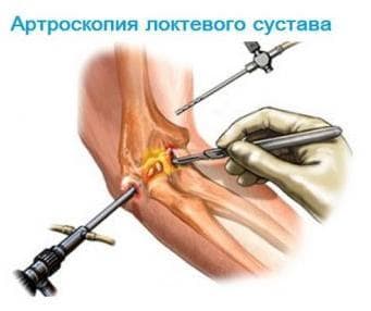 Артроскопия связок локтя в Красноярске