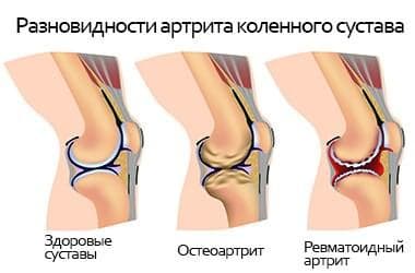 Болезни коленного сустава