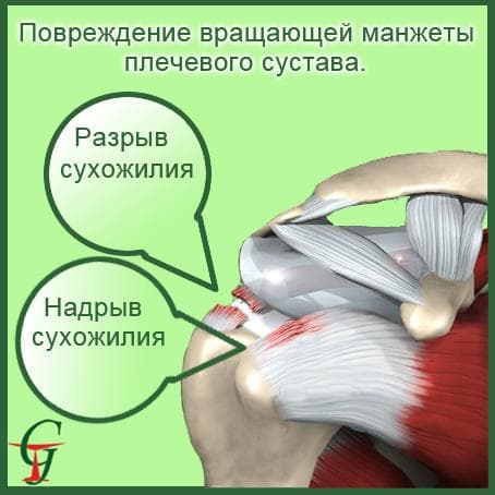 Повреждение вращательной (ротаторной) манжеты плечевого сустава
